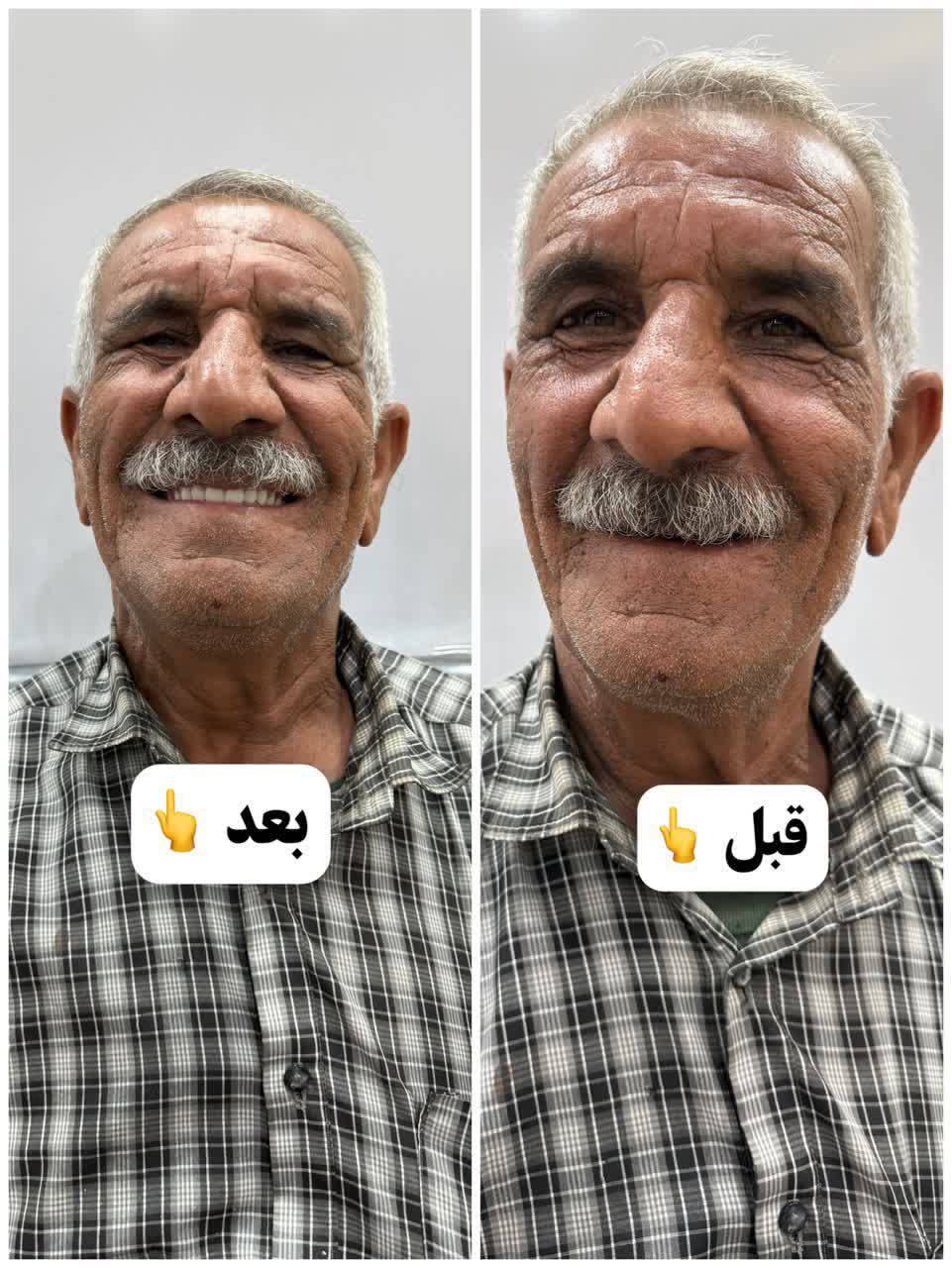 دندانسازی سید محمود هاشمی ساخت دندان مصنوعی طرح لمینتی در یزد