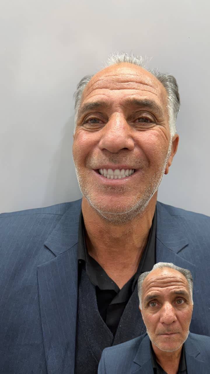 دندانسازی سید محمود هاشمی ساخت دندان مصنوعی طرح لمینتی در یزد