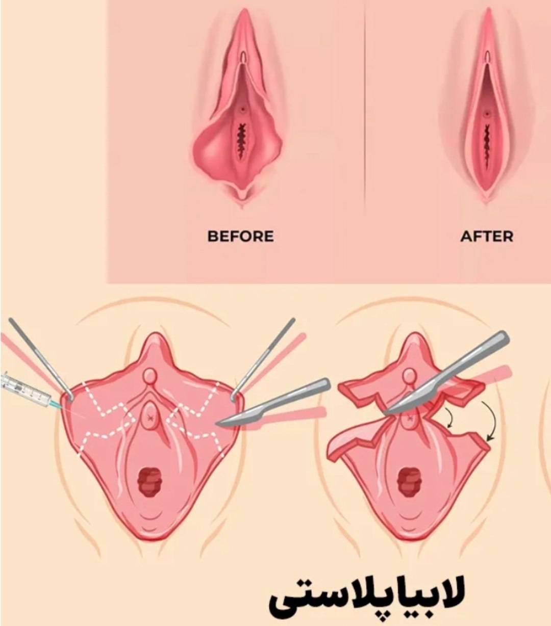 لابیا پلاستی زینب بهاروند در خرم آباد