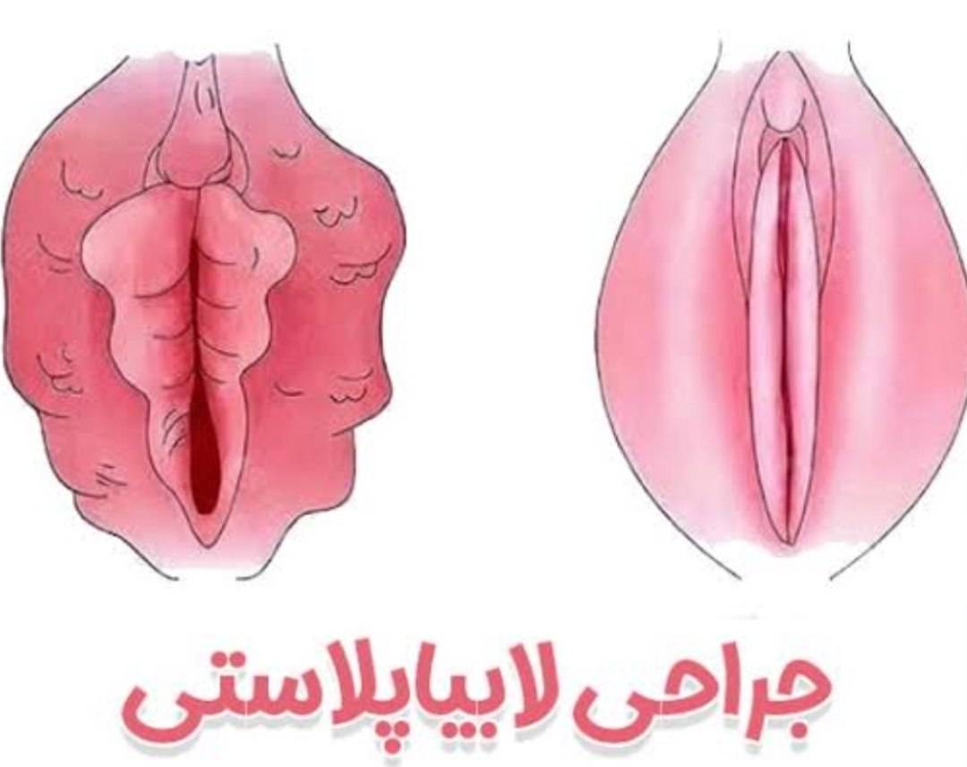 لابیا پلاستی زینب بهاروند در خرم آباد