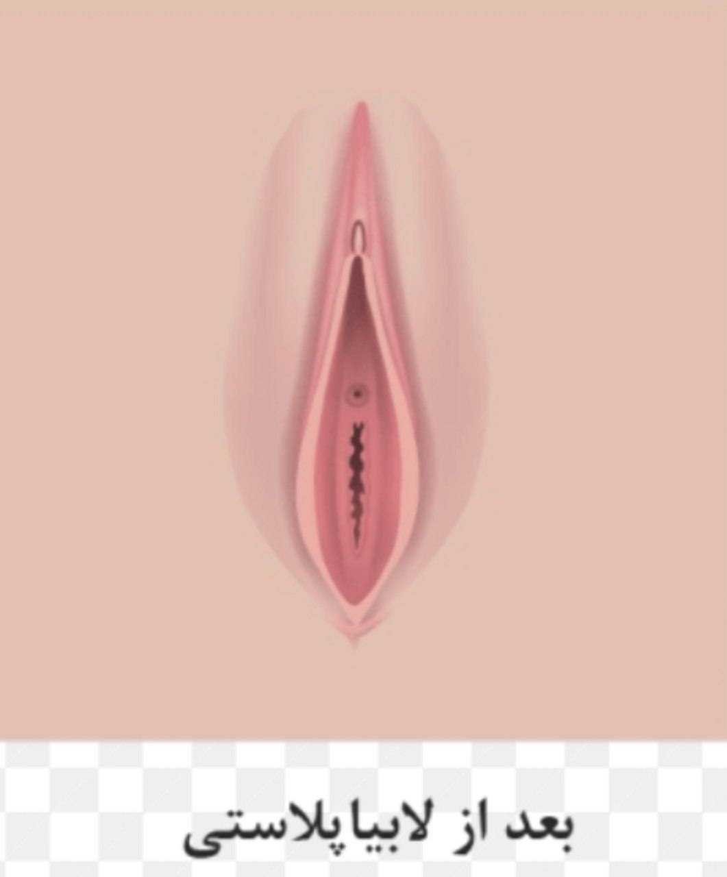 لابیا پلاستی زینب بهاروند در خرم آباد