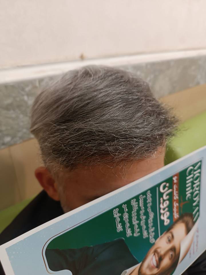 خدمات کاشت مو و ابرو کلینیک مورویان در مهاباد آذربایجان غربی