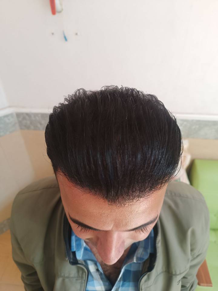 خدمات کاشت مو و ابرو کلینیک مورویان در مهاباد آذربایجان غربی