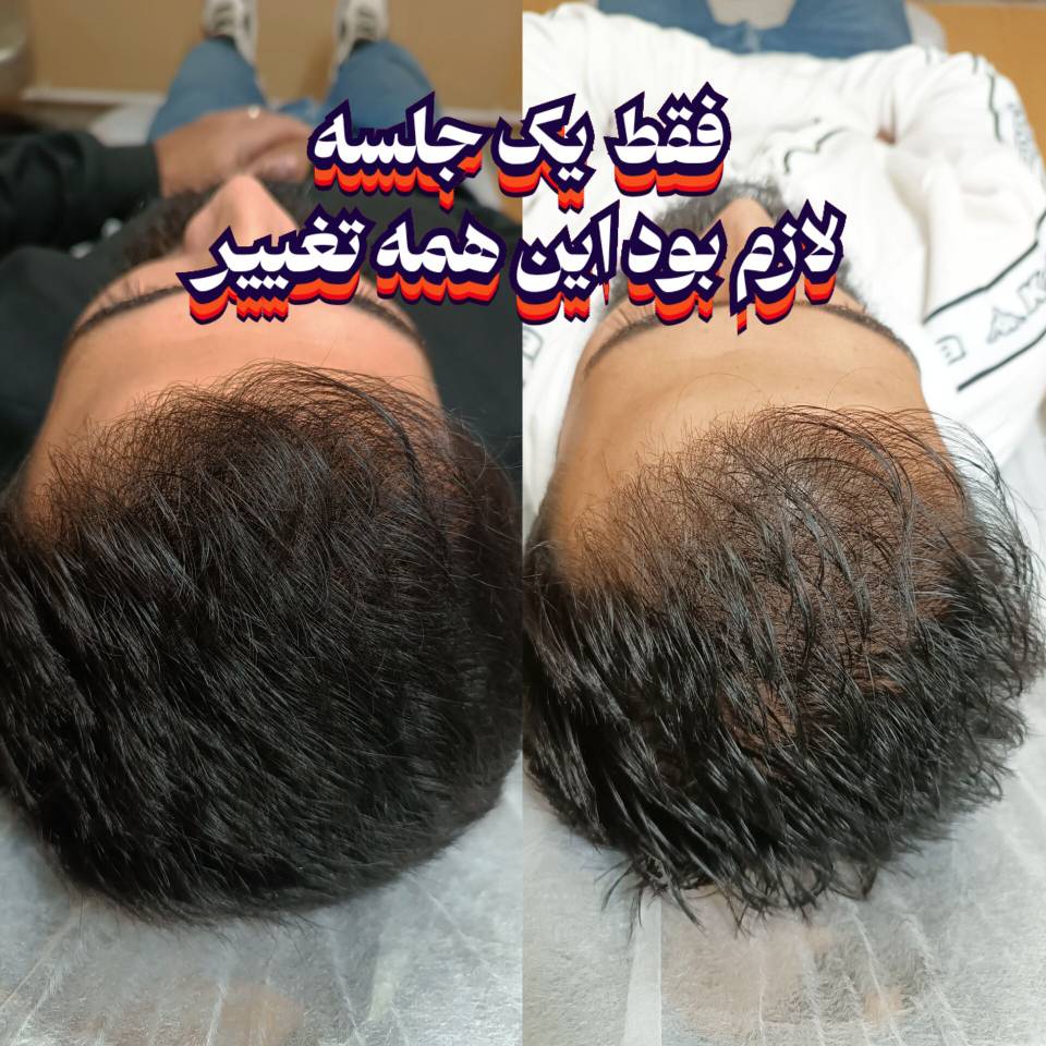 خدمات کاشت مو و ابرو کلینیک مورویان در مهاباد آذربایجان غربی