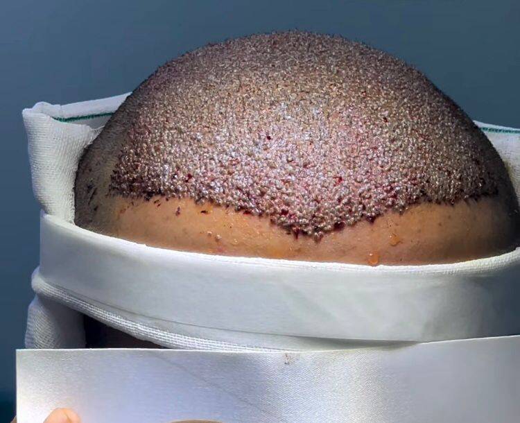 خدمات کاشت مو و ابرو کلینیک مورویان در مهاباد آذربایجان غربی