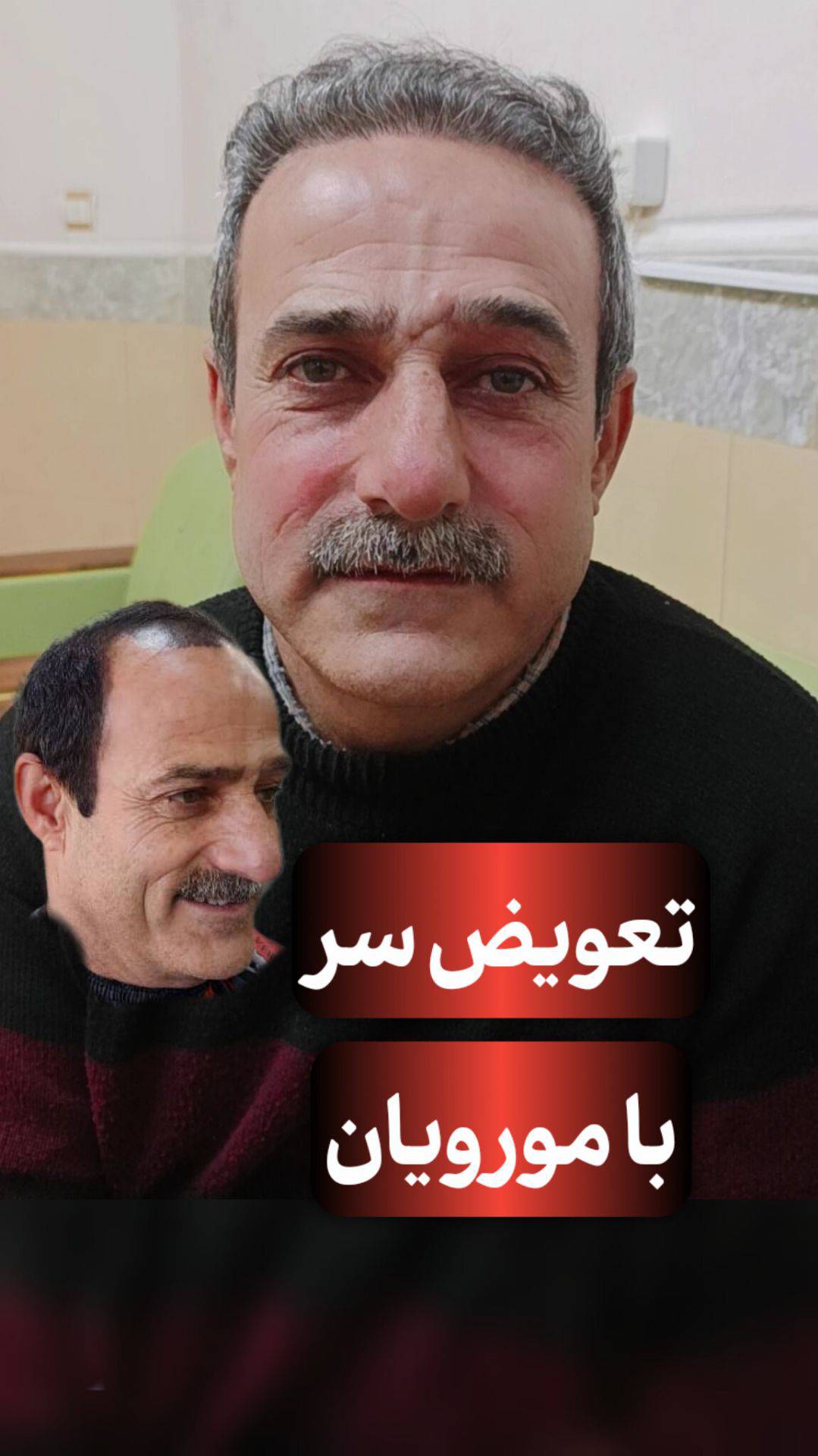 خدمات کاشت مو و ابرو کلینیک مورویان در مهاباد آذربایجان غربی