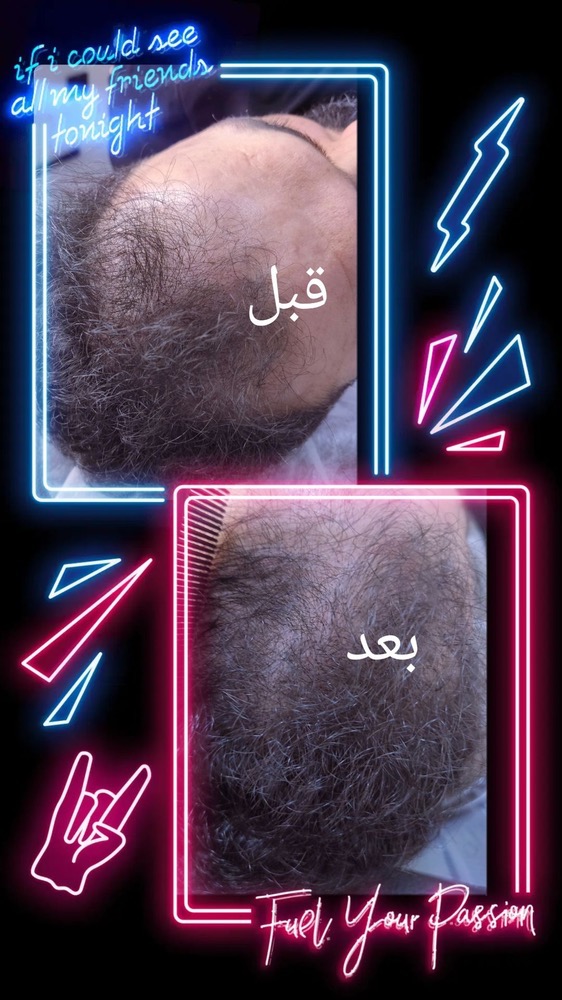 خدمات میکرواسکالپ نازنین عراقی در رشت