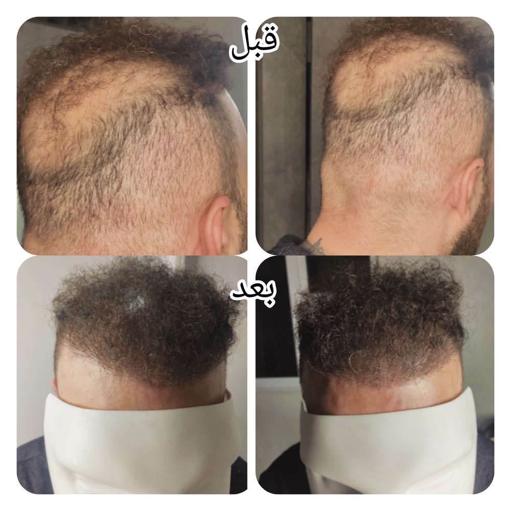 خدمات میکرواسکالپ نازنین عراقی در رشت