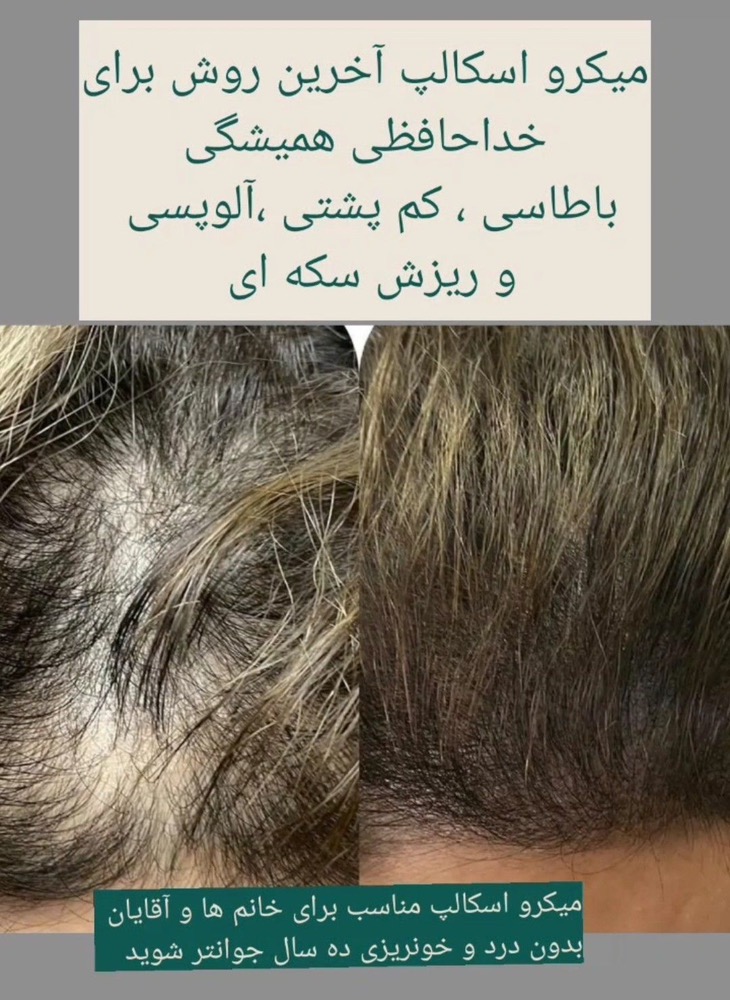 خدمات میکرواسکالپ نازنین عراقی در رشت