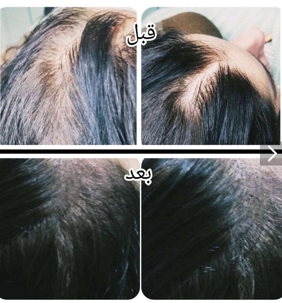 خدمات میکرواسکالپ نازنین عراقی در رشت