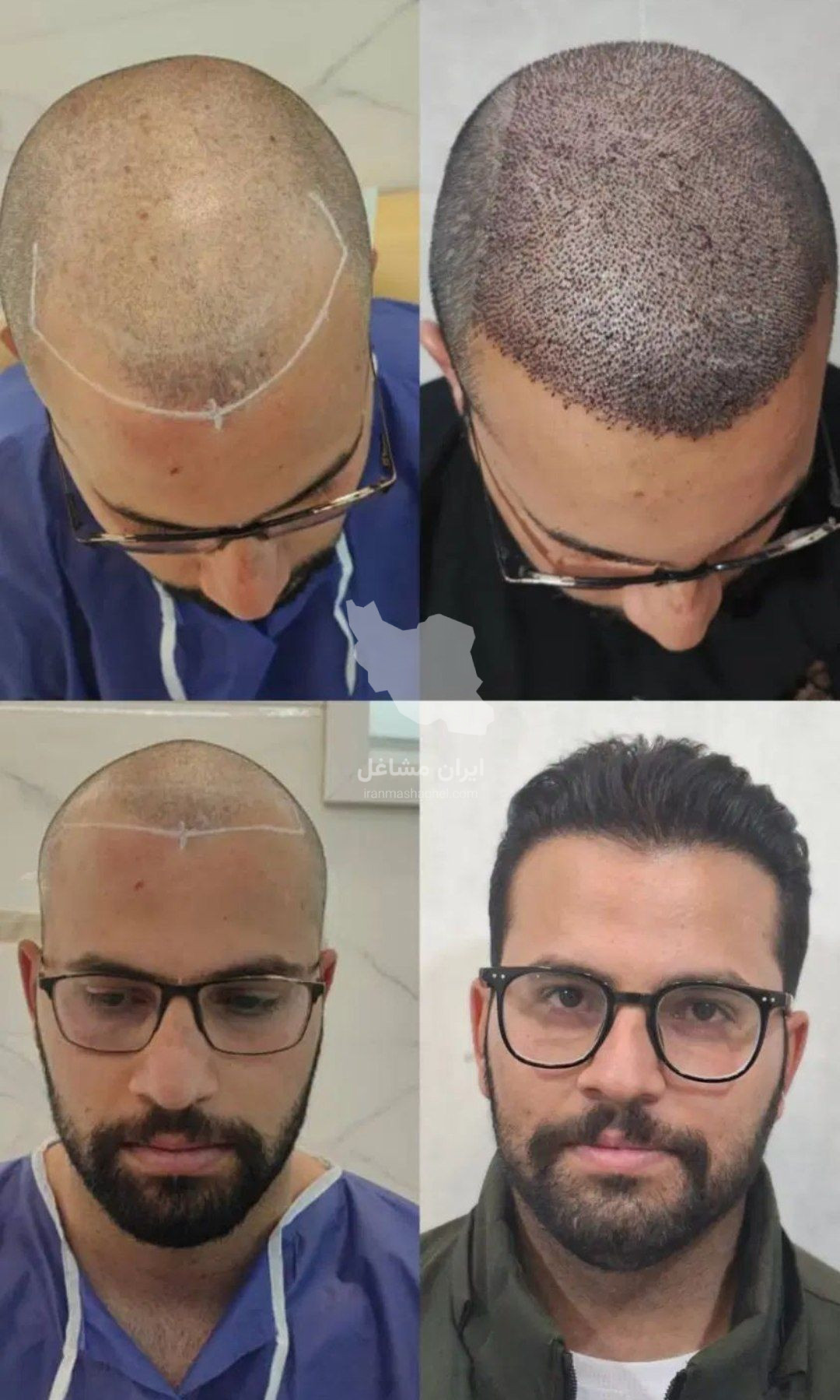 کلینیک کاشت مو دستانی در شیراز