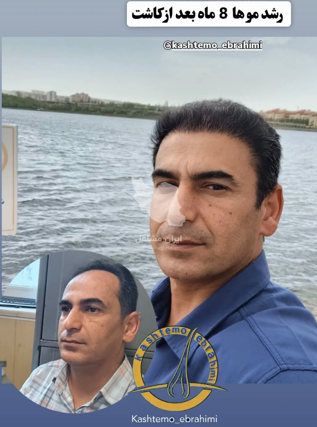 مرکز تخصصی کاشت مو و ابرو علی ابراهیمی در بناب
