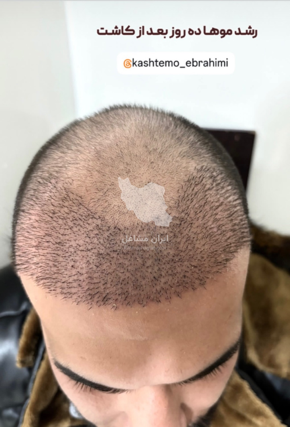 مرکز تخصصی کاشت مو و ابرو علی ابراهیمی در بناب