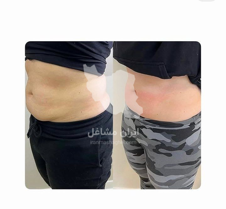 کلینیک تخصصی درمان ترک های پوستی گندم در یزد