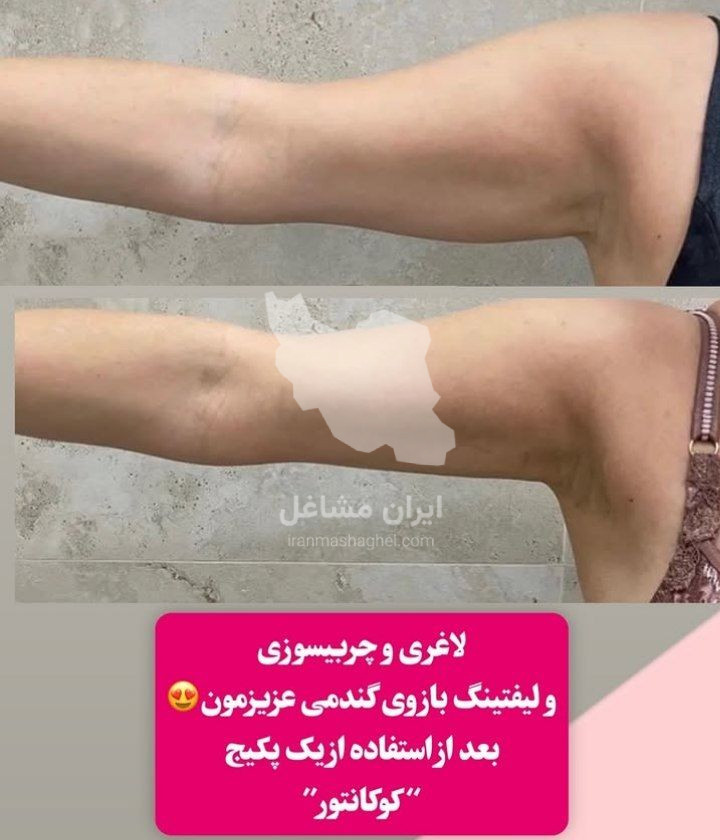کلینیک تخصصی درمان ترک های پوستی گندم در یزد
