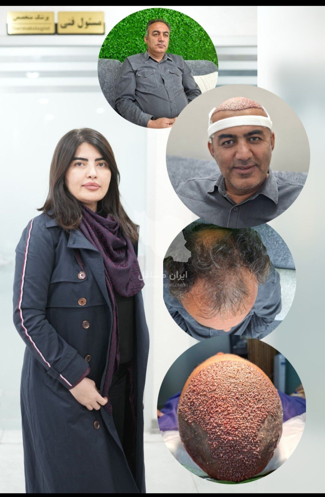کلینیک کاشت مو دستانی در شیراز