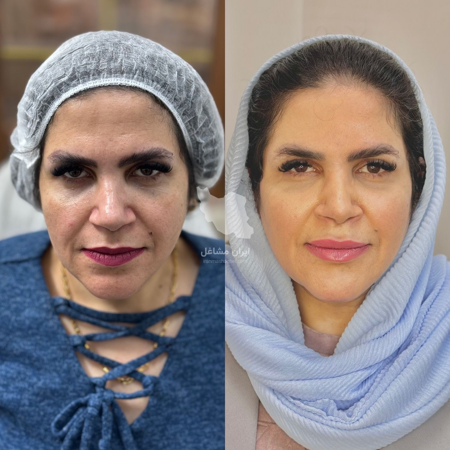 کلینیک زیبایی نینا در قائم شهر