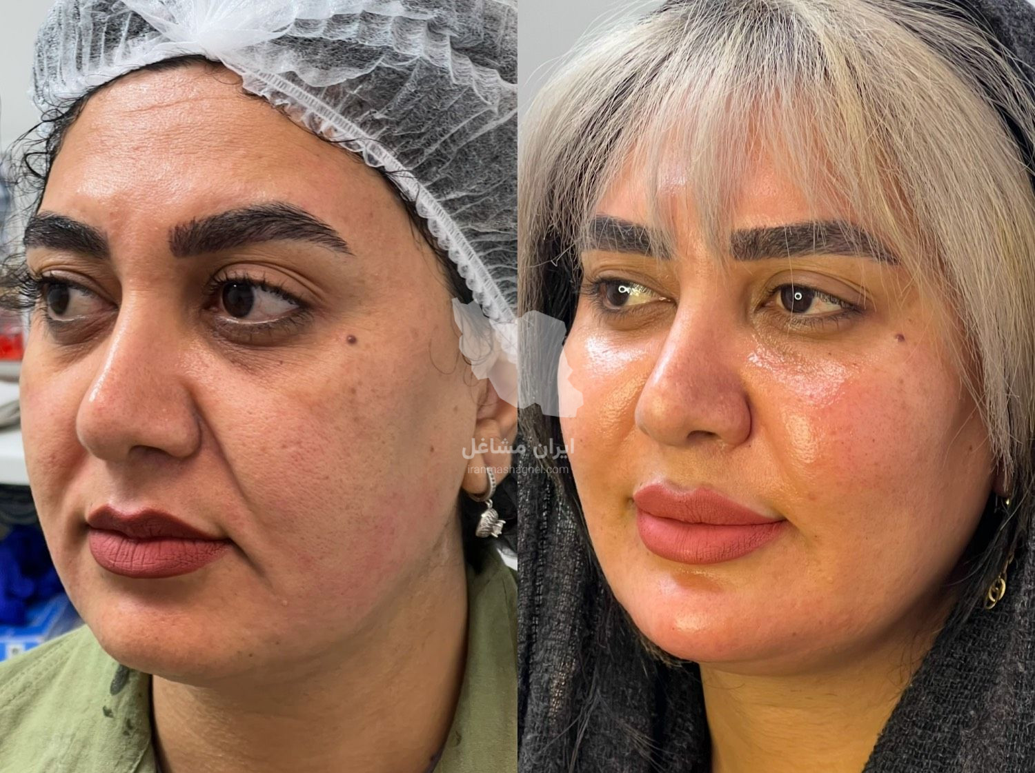کلینیک زیبایی نینا در قائم شهر