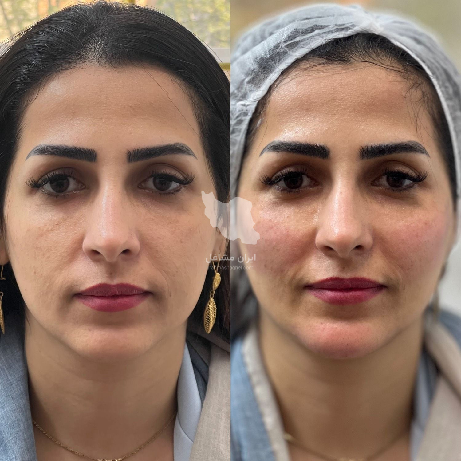 کلینیک زیبایی نینا در قائم شهر