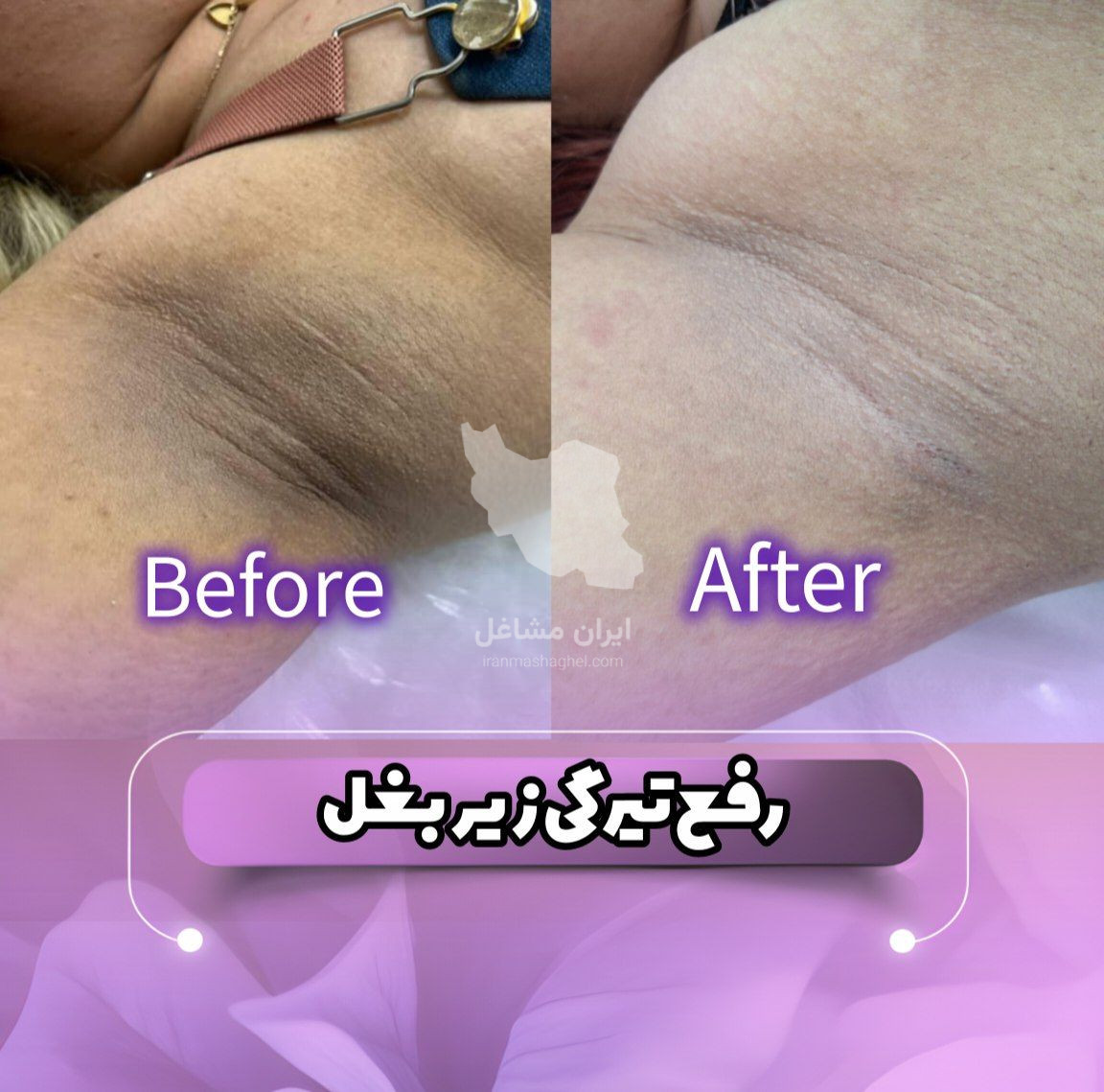 مرکز تخصصی روشن سازی بدن با لیزر نایس قاعدی رفسنجان