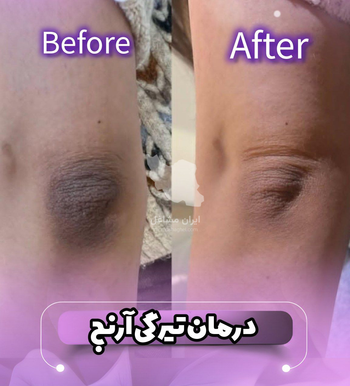 مرکز تخصصی روشن سازی بدن با لیزر نایس قاعدی رفسنجان