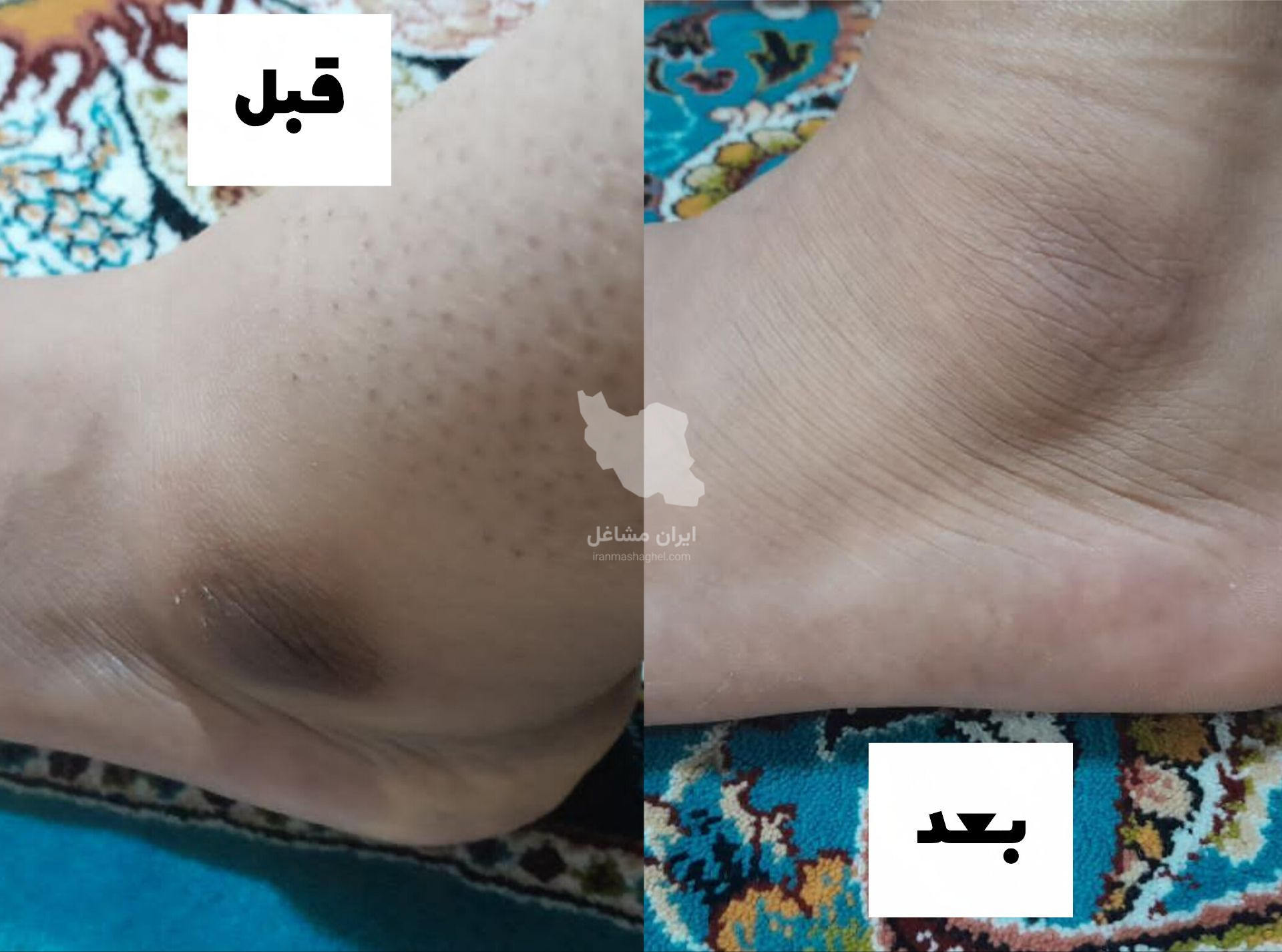 مرکز تخصصی روشن سازی بدن با لیزر نایس قاعدی رفسنجان