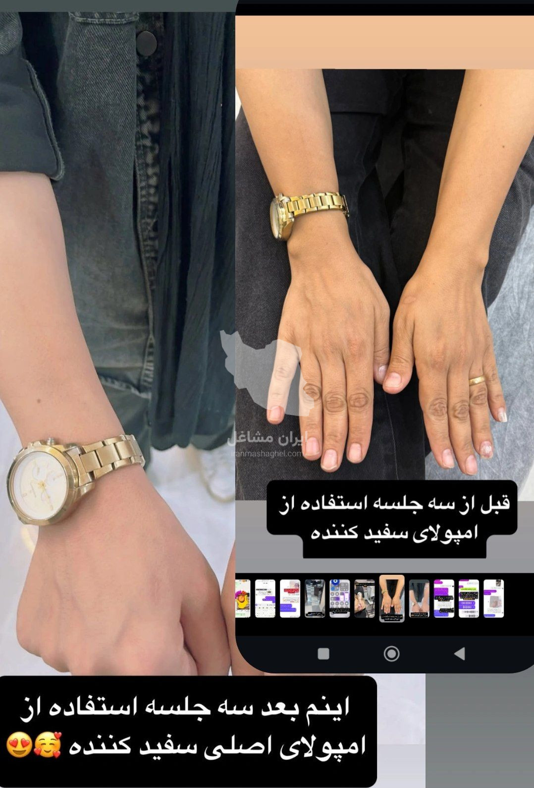 فروش و تزریق سرم سفیدکننده کل بدن لیل در بوکان