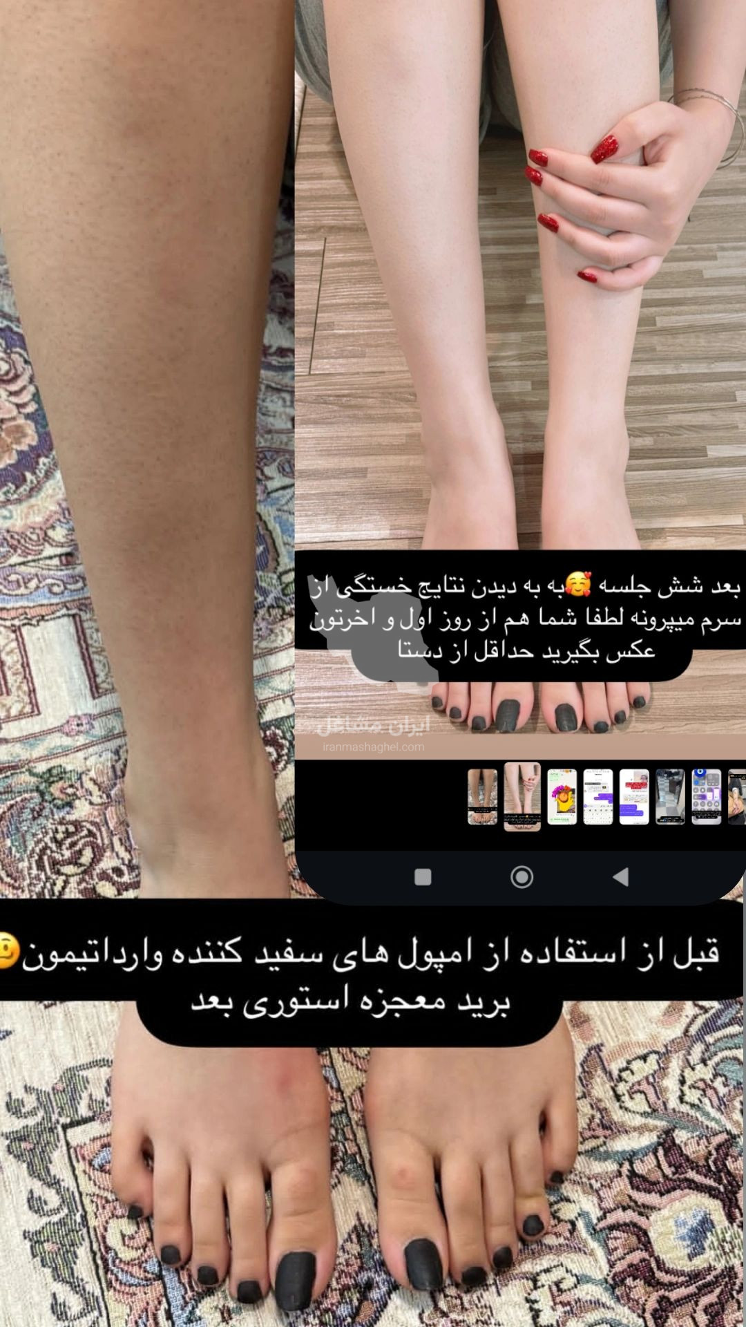 فروش و تزریق سرم سفیدکننده کل بدن لیل در بوکان
