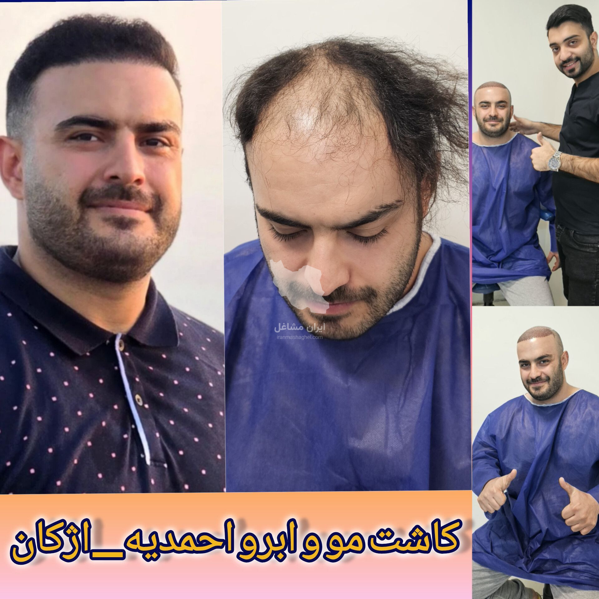مرکز تخصصی کاشت مو و ابرو احمدیه اژکان در تربت حیدریه
