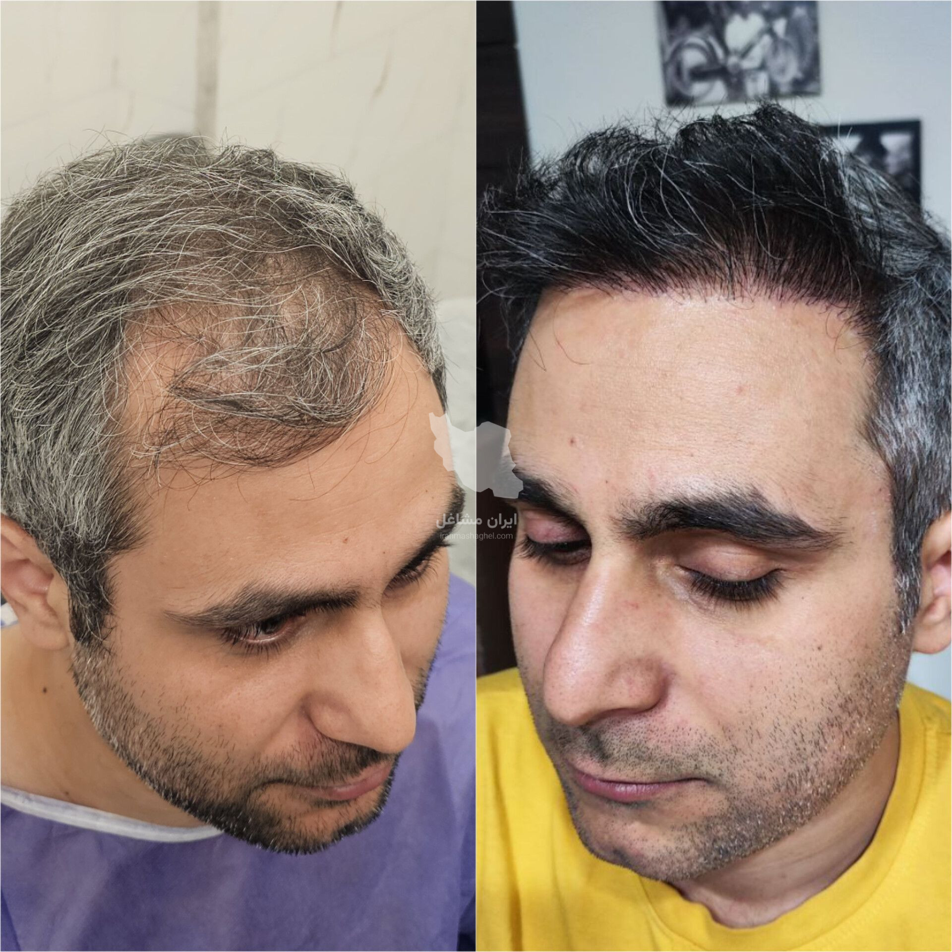 مرکز تخصصی کاشت مو و ابرو احمدیه اژکان در تربت حیدریه