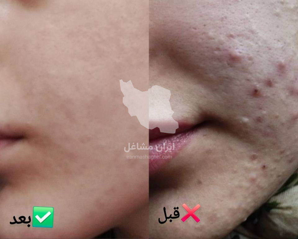 آموزش فیشیال و جوانسازی پوست به مدیریت خانم سحر پیکر در بهبهان