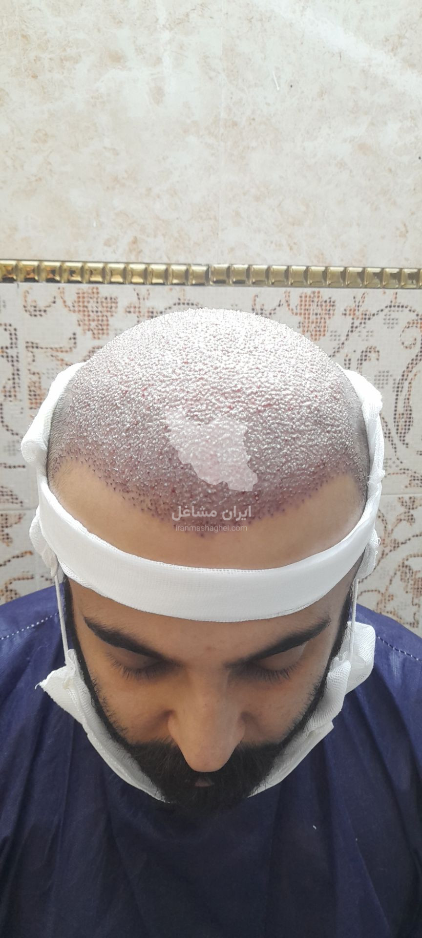 کلینیک کاشت مو تخصصی به صورت اقساطی رضاپور در بابل