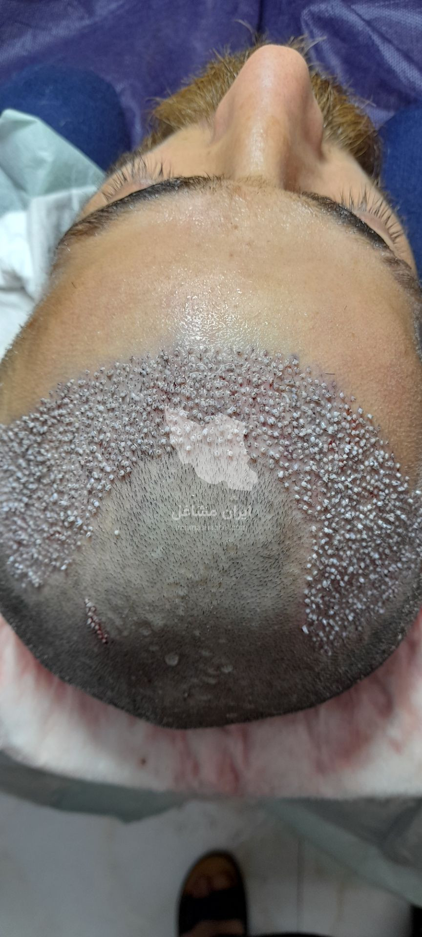 کلینیک کاشت مو تخصصی به صورت اقساطی رضاپور در بابل