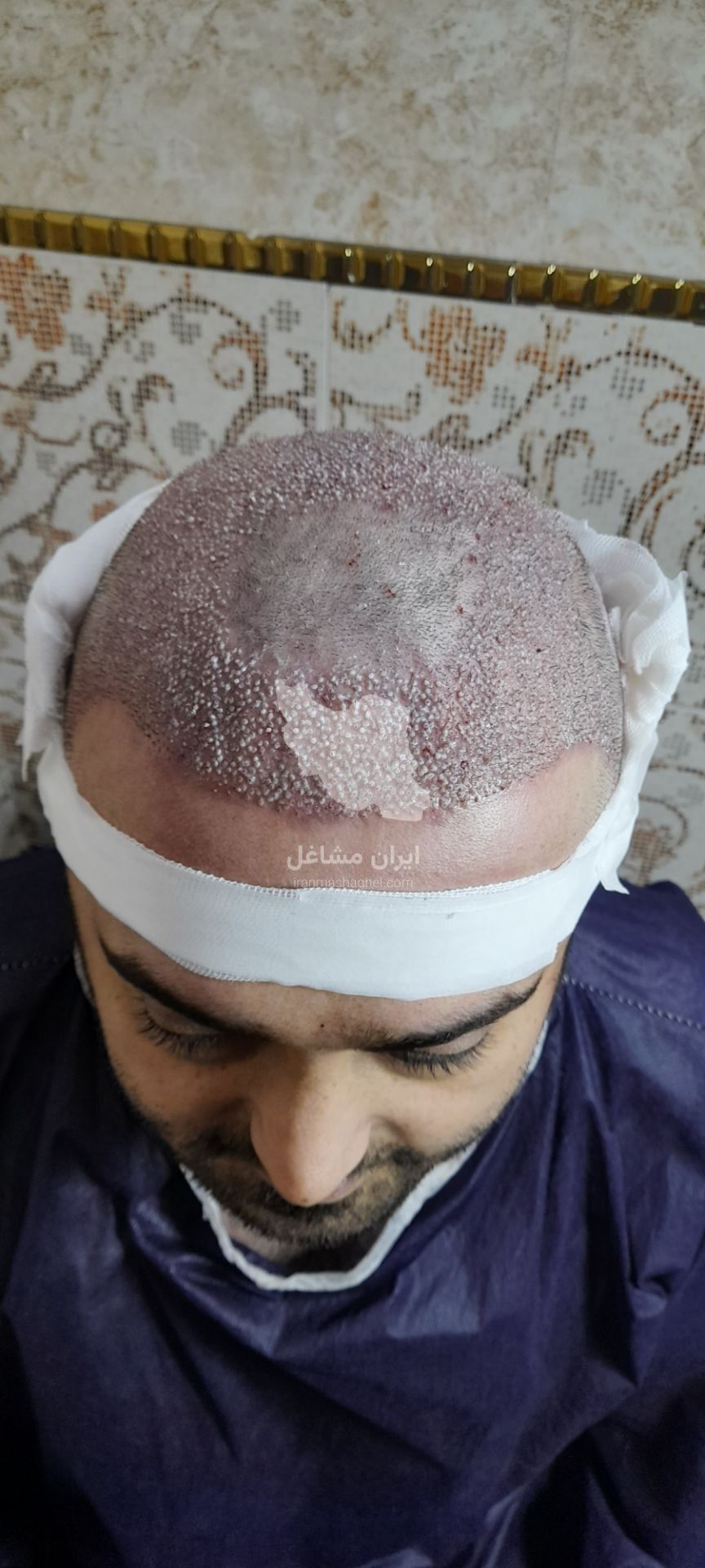 کلینیک کاشت مو تخصصی به صورت اقساطی رضاپور در بابل