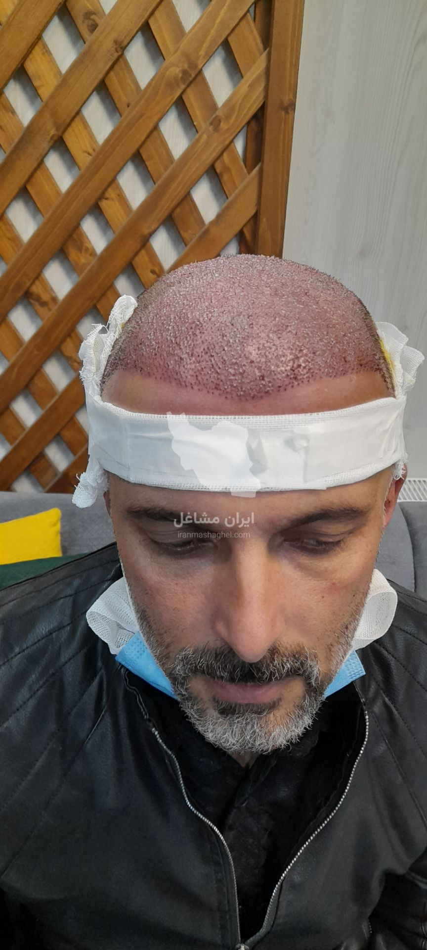 کلینیک کاشت مو تخصصی به صورت اقساطی رضاپور در بابل