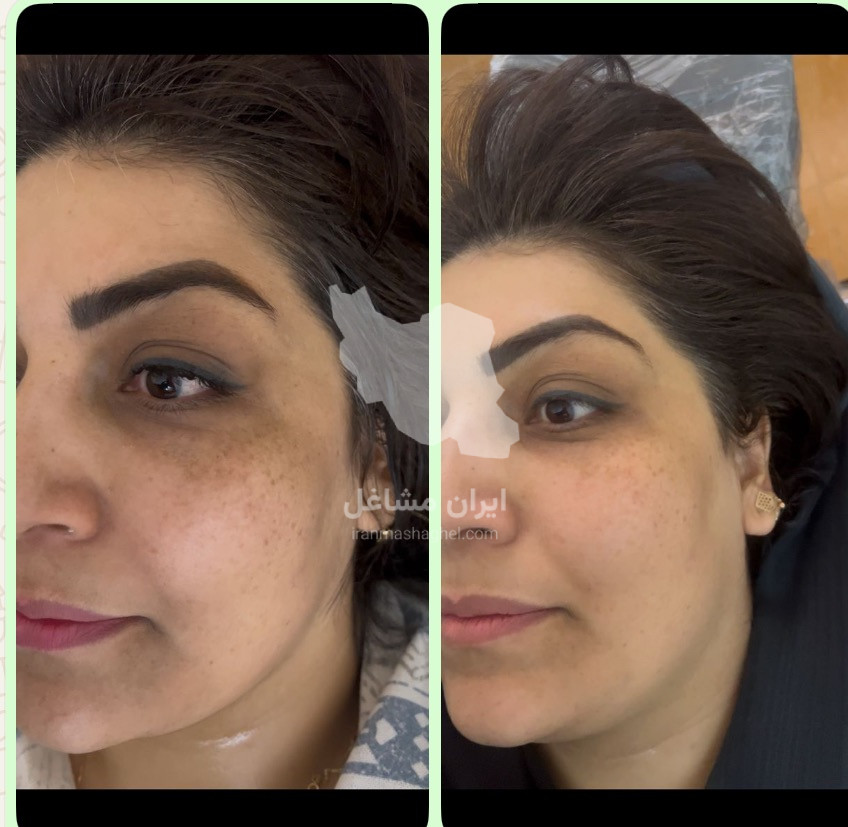 مرکز تخصصی روشن سازی بدن با لیزر نایس قاعدی رفسنجان