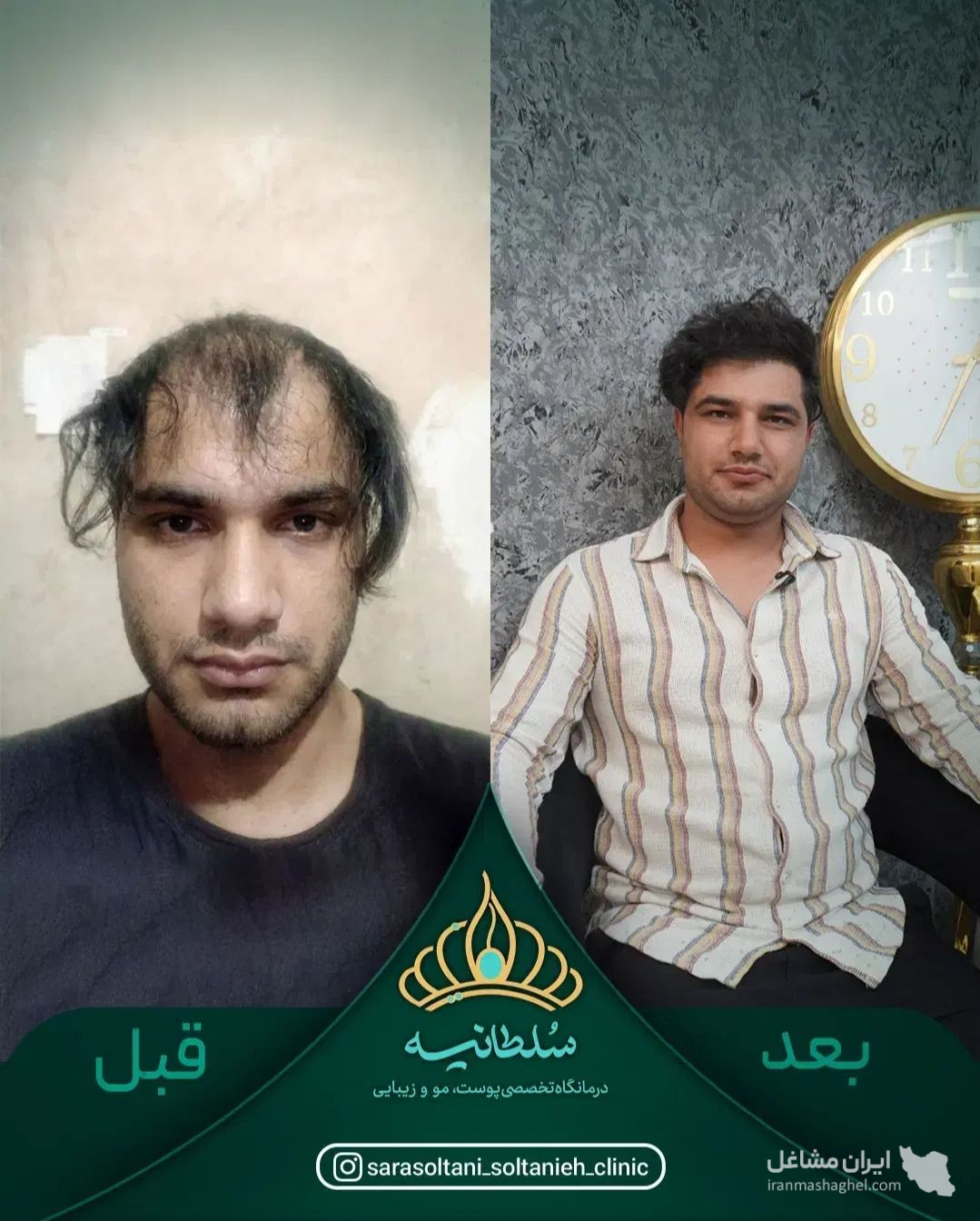 کلینیک کاشت مو سلطانیه در حافظیه شیراز