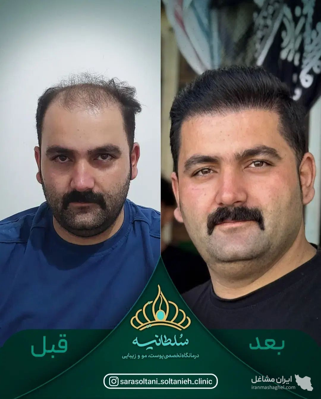کلینیک کاشت مو سلطانیه در حافظیه شیراز