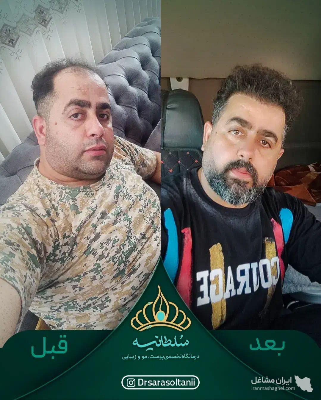 کلینیک کاشت مو سلطانیه در حافظیه شیراز