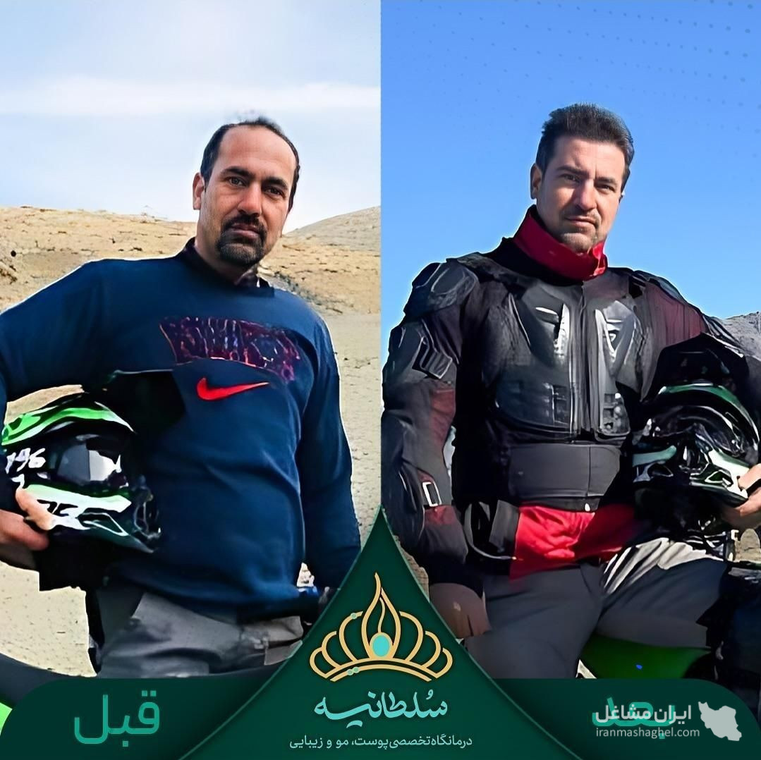 کلینیک کاشت مو سلطانیه در حافظیه شیراز