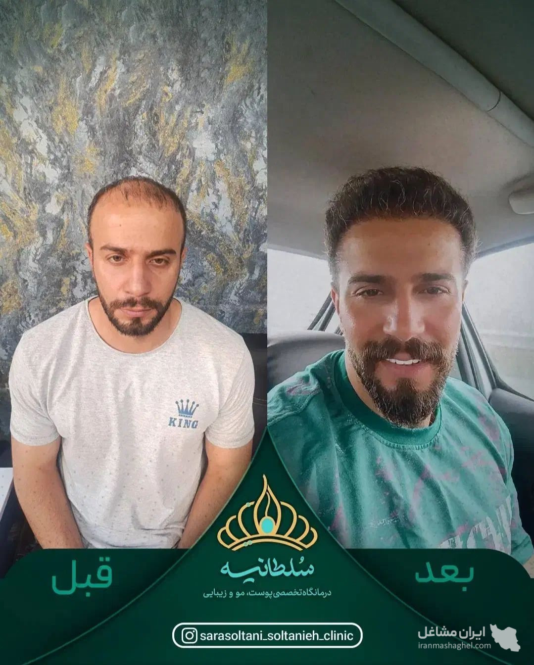 کلینیک کاشت مو سلطانیه در حافظیه شیراز
