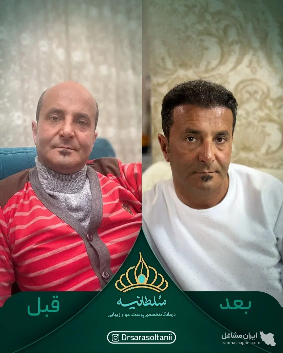 کلینیک کاشت مو سلطانیه در حافظیه شیراز