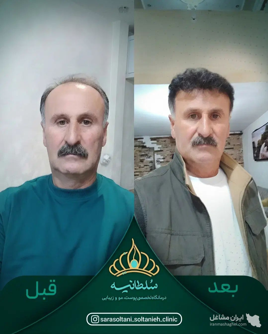 کلینیک کاشت مو سلطانیه در حافظیه شیراز