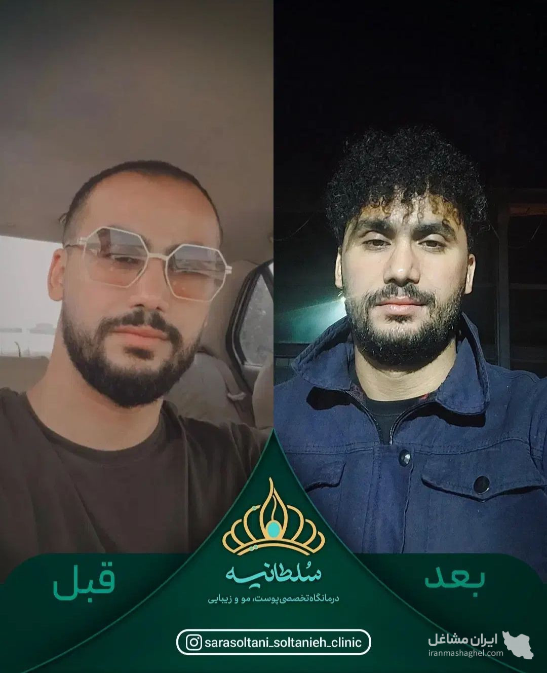 کلینیک کاشت مو سلطانیه در حافظیه شیراز