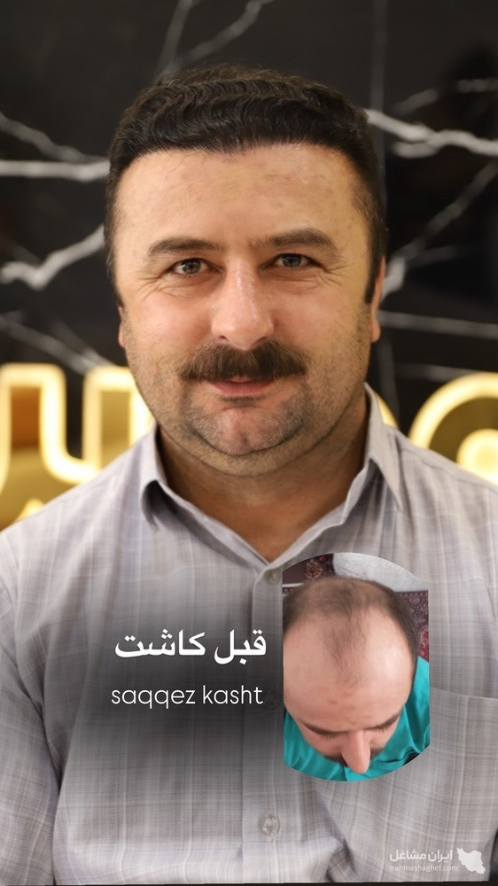 کلینیک کاشت مو و ابرو سقز کاشت در سقز