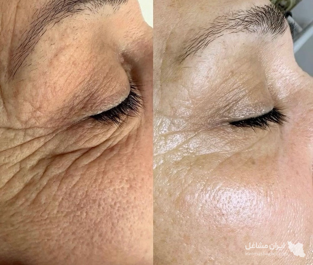 آموزش و خدمات تخصصی پاکسازی پوست و فشیال صورت هدیه تقویان در مشهد