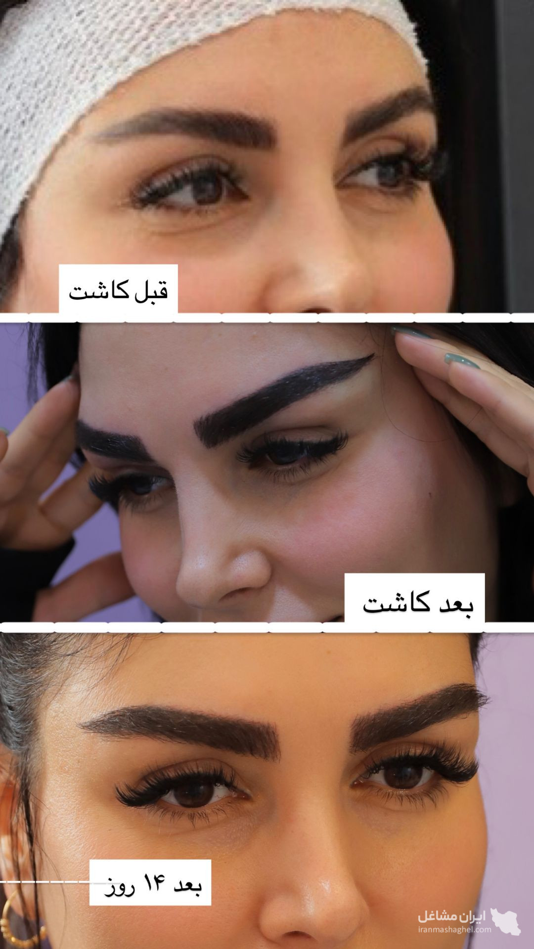 کلینیک کاشت مو و ابرو سقز کاشت در سقز