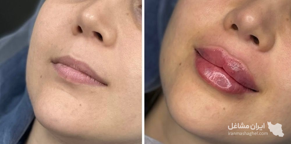 کلینیک تزریق ژل ستی در گرگان