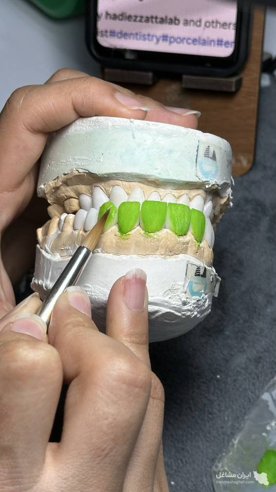 متخصص دیجیتال پروتزهای دندانی و کاستومایز اباتمنت تاژانی منطقه یک تهران