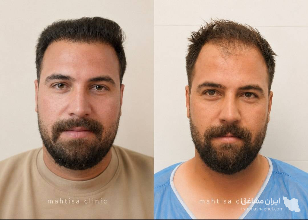 کلینیک تخصصی کاشت مو و ابرو ماهتیسا در بابل